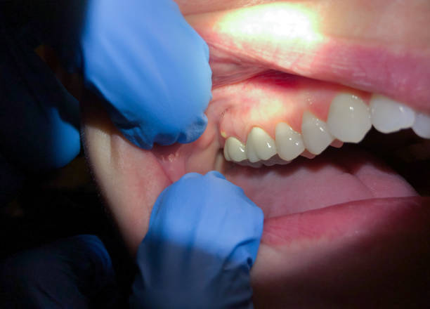 Best Emergency Root Canal Treatment in Brandywine, MD